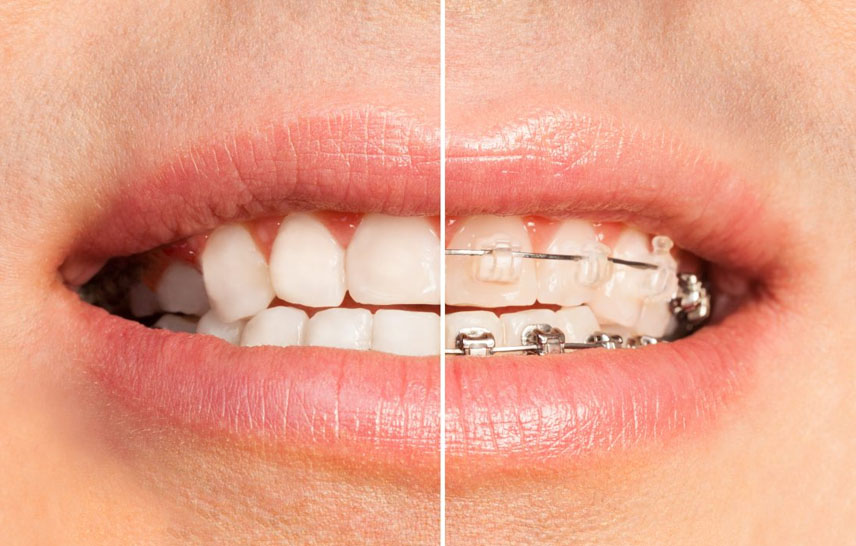 Ceramic Braces Vs Invisalign®: Which Is Best For Your Smile?